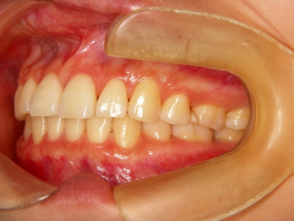 矯正治療で顔が変わる 川越で痛みが少ない歯医者 歯列矯正 小児歯科なら大東にし歯科医院